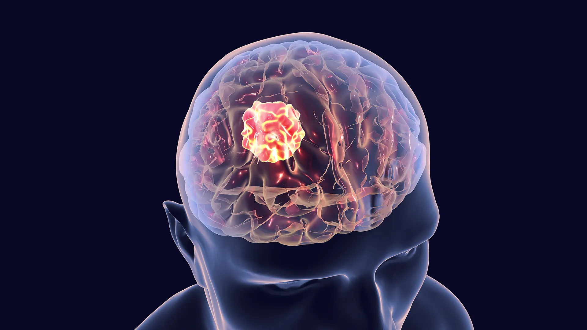 Shocking brain cancer breakthrough: Electric fields supercharge immune assault