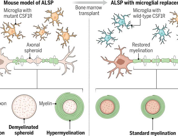 Replacing microglia to treat a brain disease | Science