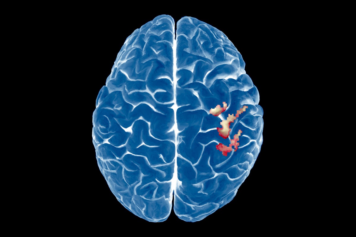 The Brain’s Map of the Body Is Surprisingly Stable—Even after a Limb Is Lost