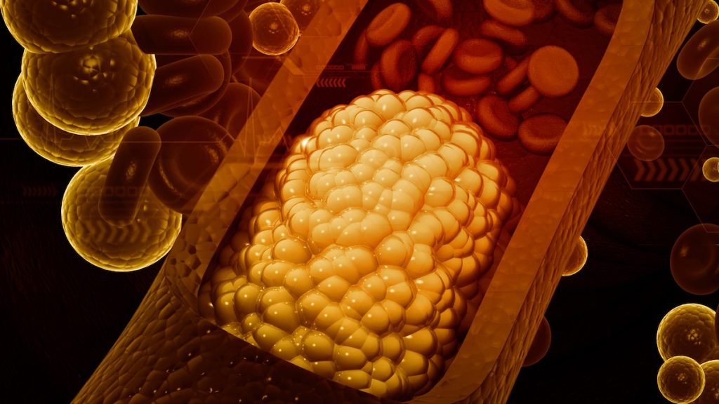 High cholesterol can be inherited. Here’s what you can do about it