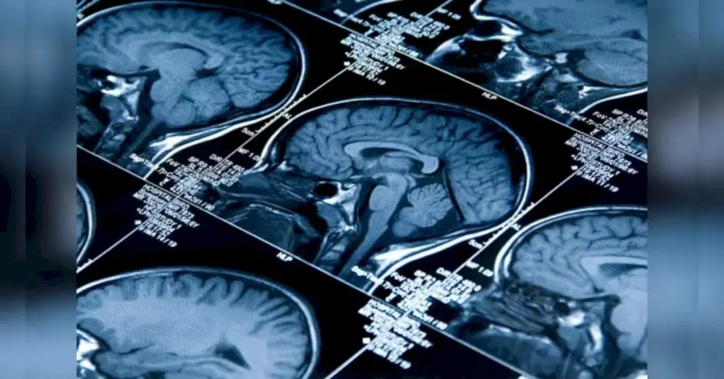 AI Maps Show Brain Regions Age at Different Rates