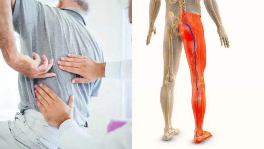 Leg pain that travels from the back may be sciatica, doctors warn