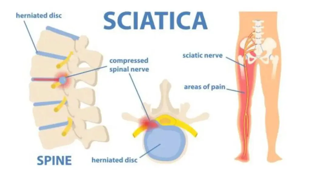 Leg pain that travels from the back may be sciatica, doctors warn