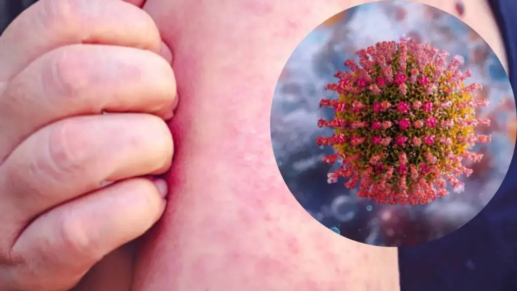 WHO warns 11 million could contract measles in 2026 as vaccination rates fall