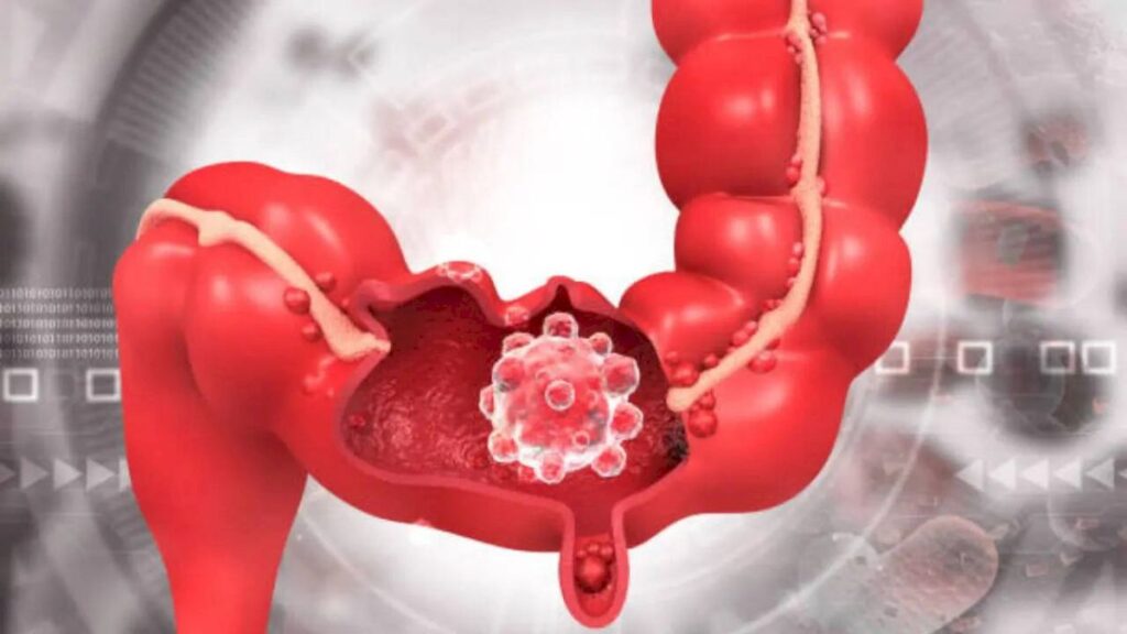 Colorectal cancer now India's 4th most common cancer: WHO-IARC