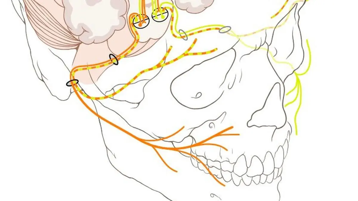 Hemifacial spasm curable by surgery, says Pune neurosurgeon