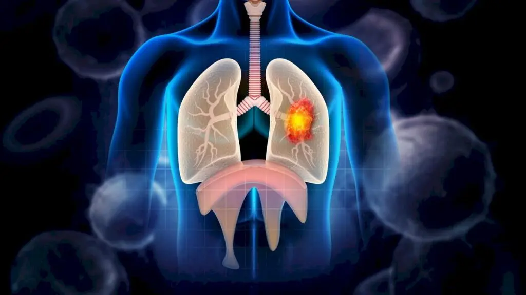 Lung cancer is 6% of Karnataka's new cancer cases, KMIO data shows