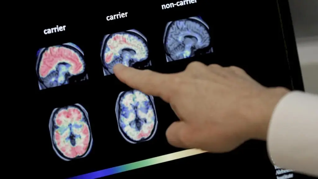 Study identifies diabetes, hearing loss as key dementia factors in India