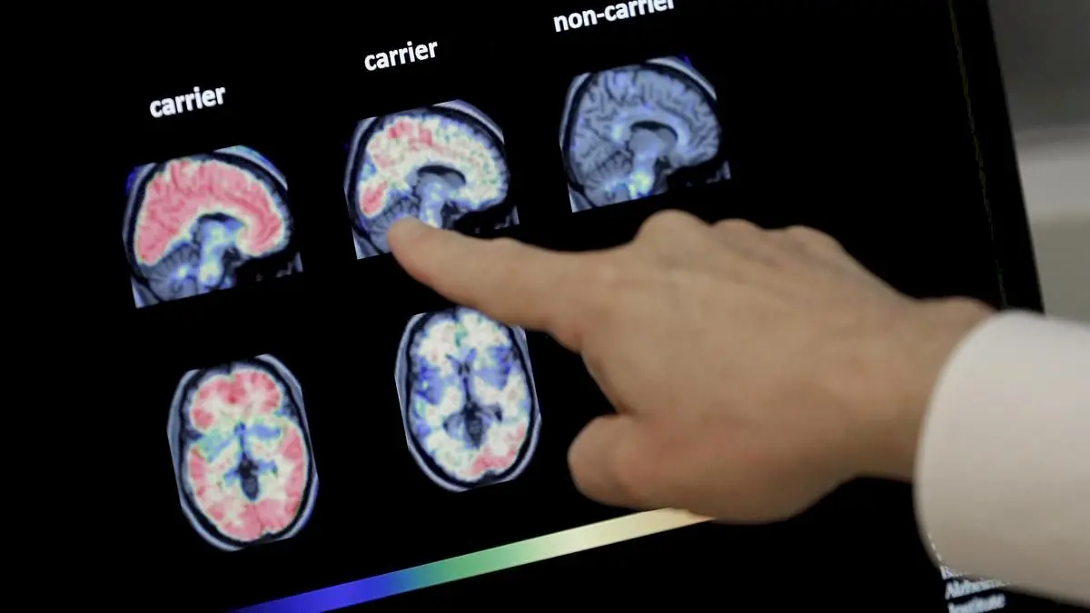 Study identifies diabetes, hearing loss as key dementia factors in India