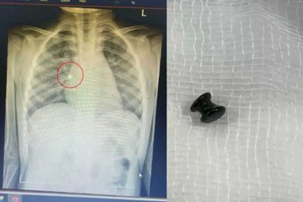 Toddler in Kochi saved after inhaling toy pearl, doctors warn parents