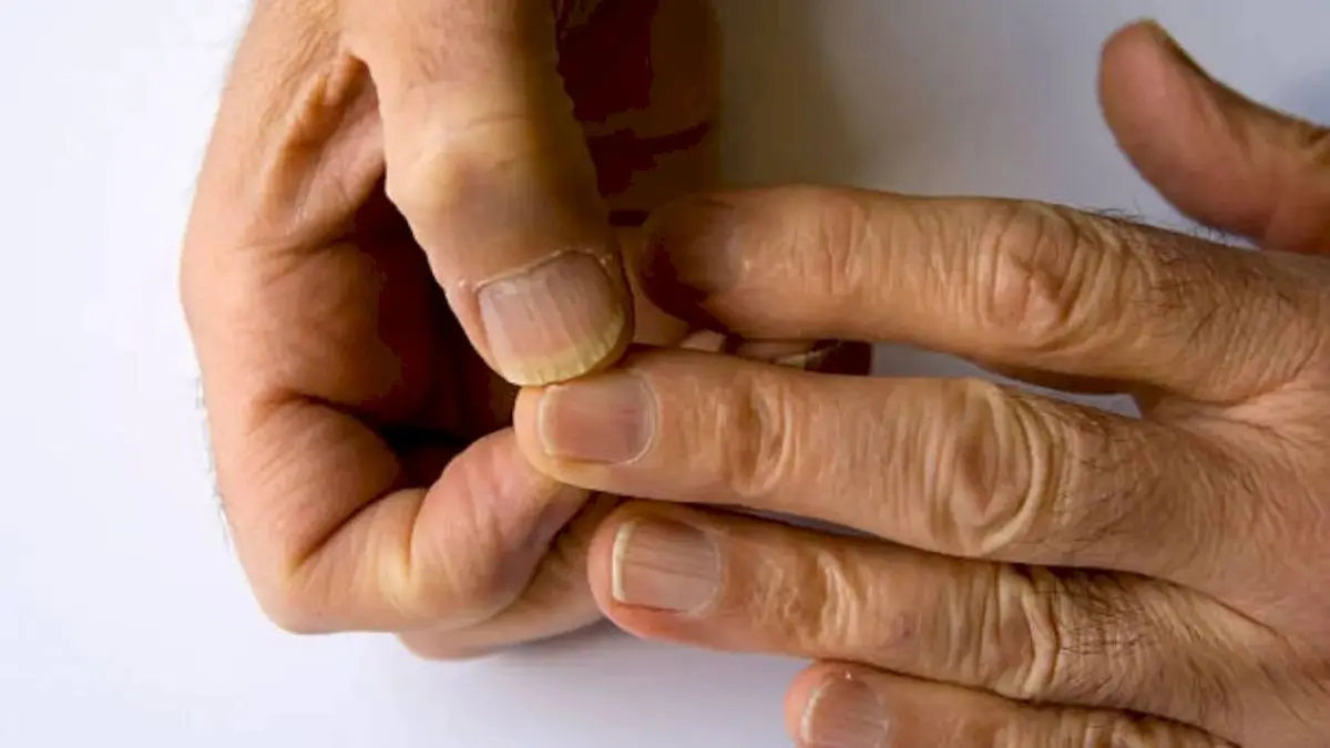 5 Nail Changes That Signal Hidden Health Problems