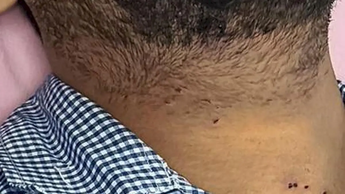 RTI data shows 10 hit by pellets in July 20 Parliament march