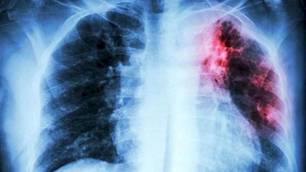 Integrated multi-testing can strengthen TB care: experts