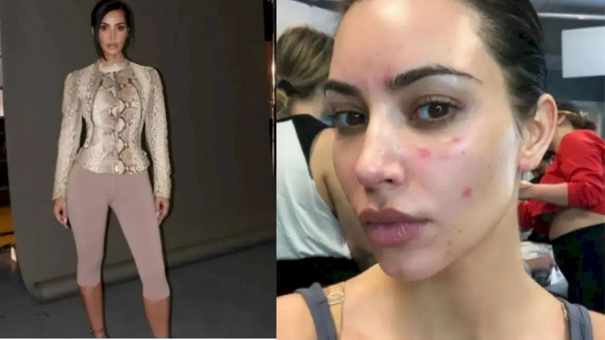 Kim Kardashian says psoriasis left her 'really insecure'
