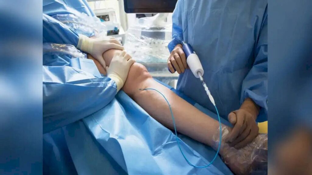 Varicose Veins Rise Among Younger Indians, Doctors Report