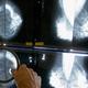 Fertility and breastfeeding possible after cancer with care, experts say