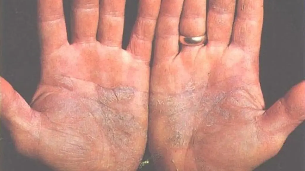 Psoriasis cases rising in India, dermatologists report