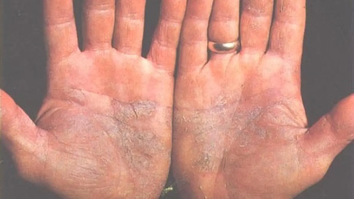 Psoriasis cases rising in India, dermatologists report