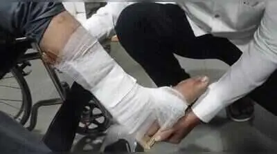 Cardboard used as splint at Thane hospital, staff suspended