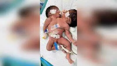 Odisha woman gives birth to conjoined twin with two heads
