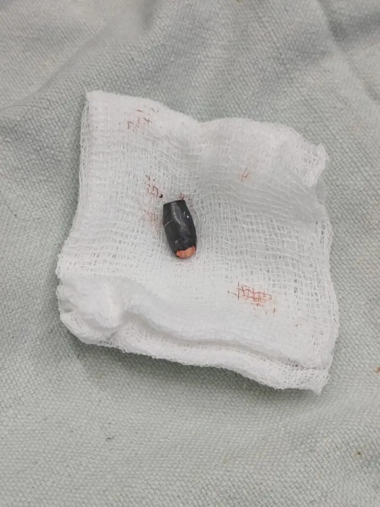 Bullet removed from Tiger Shroff firing victim at KEM Hospital