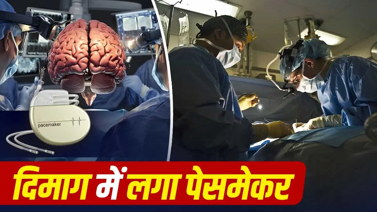 RML Hospital performs first deep brain stimulation surgery