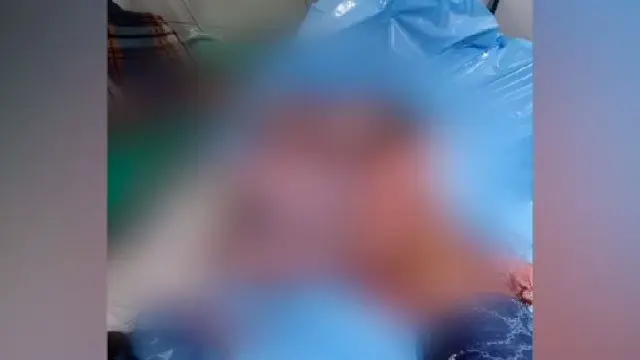 Two-headed newborn dies at Berhampur hospital